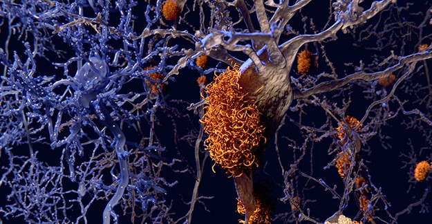 Neurons amyloid plaques